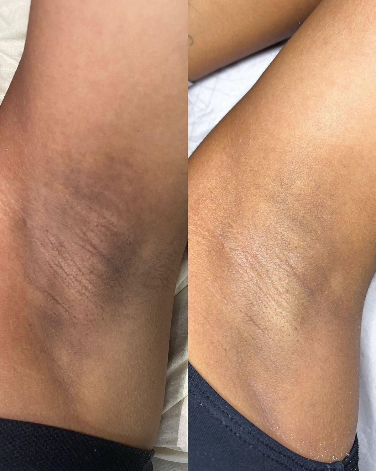 Blanqueamiento corporal