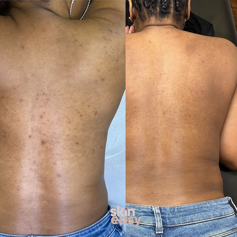 Blanqueamiento corporal